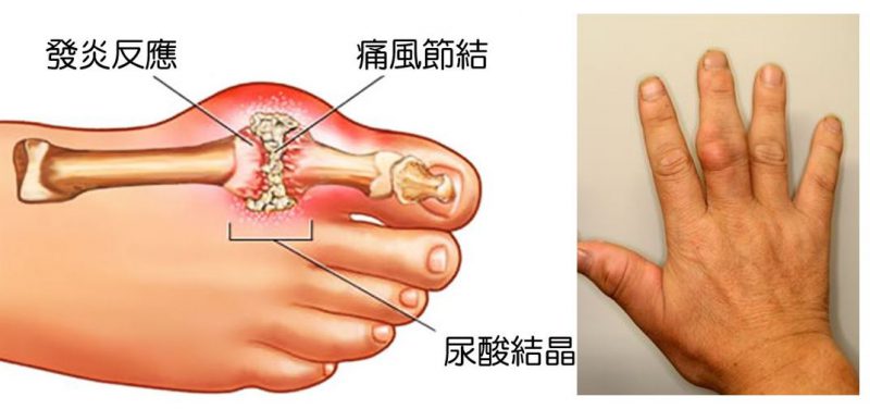 痛風急性發作：用藥莫入兩誤區