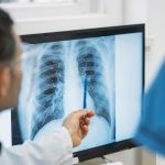 不同類型肺小結節：應區別對待