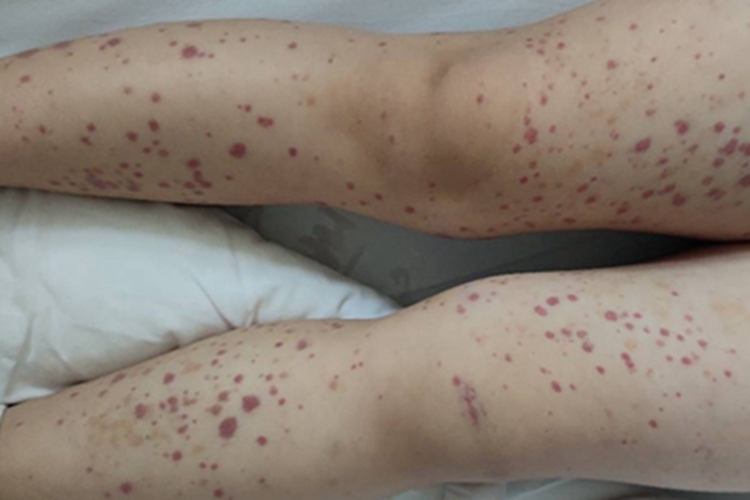 中醫調養小兒過敏性紫癜