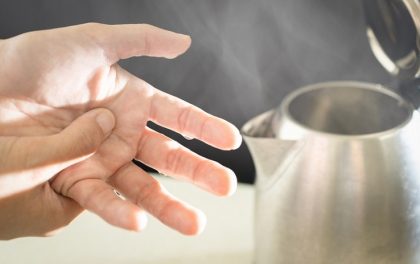 燒燙傷急救，你做對了嗎？