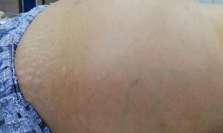 肝硬化八大併發症