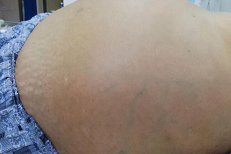 肝硬化八大併發症