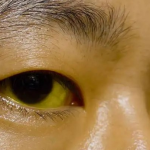胰腺癌為什麼難以發現？