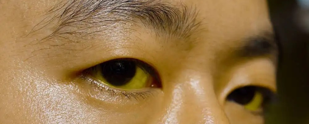 胰腺癌為什麼難以發現？