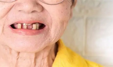 防治牙周病認識上需要糾錯